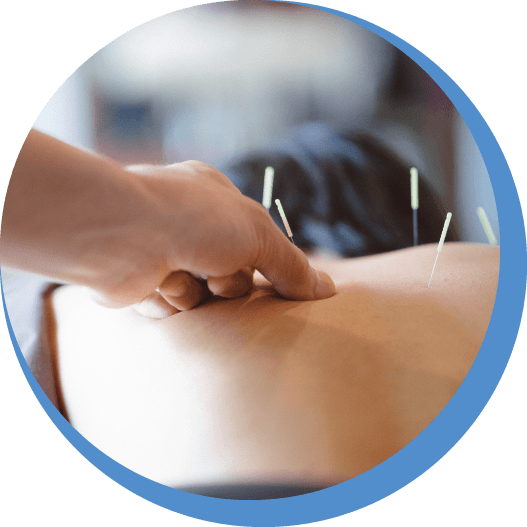 Acupuncture Treatment In Ashford